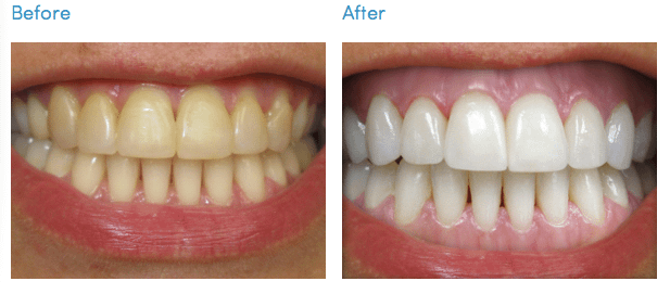 The image shows the before and after of the whitening process of teeth
