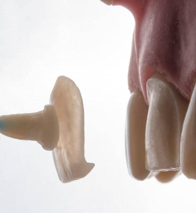 dentist placing veneers on front teeth