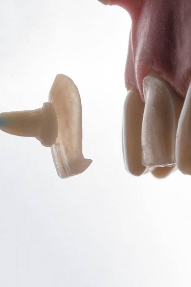 dentist placing the veneers on the front teeth